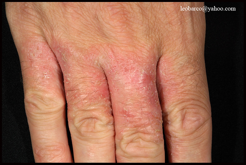 IRRITANT CONTACT DERMATITIS_01.JPG