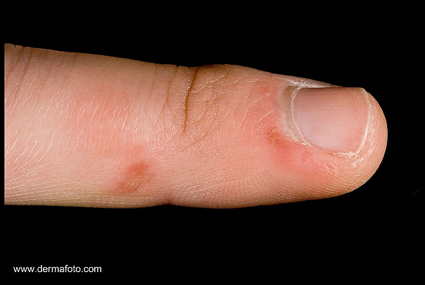 chilblains_02.JPG