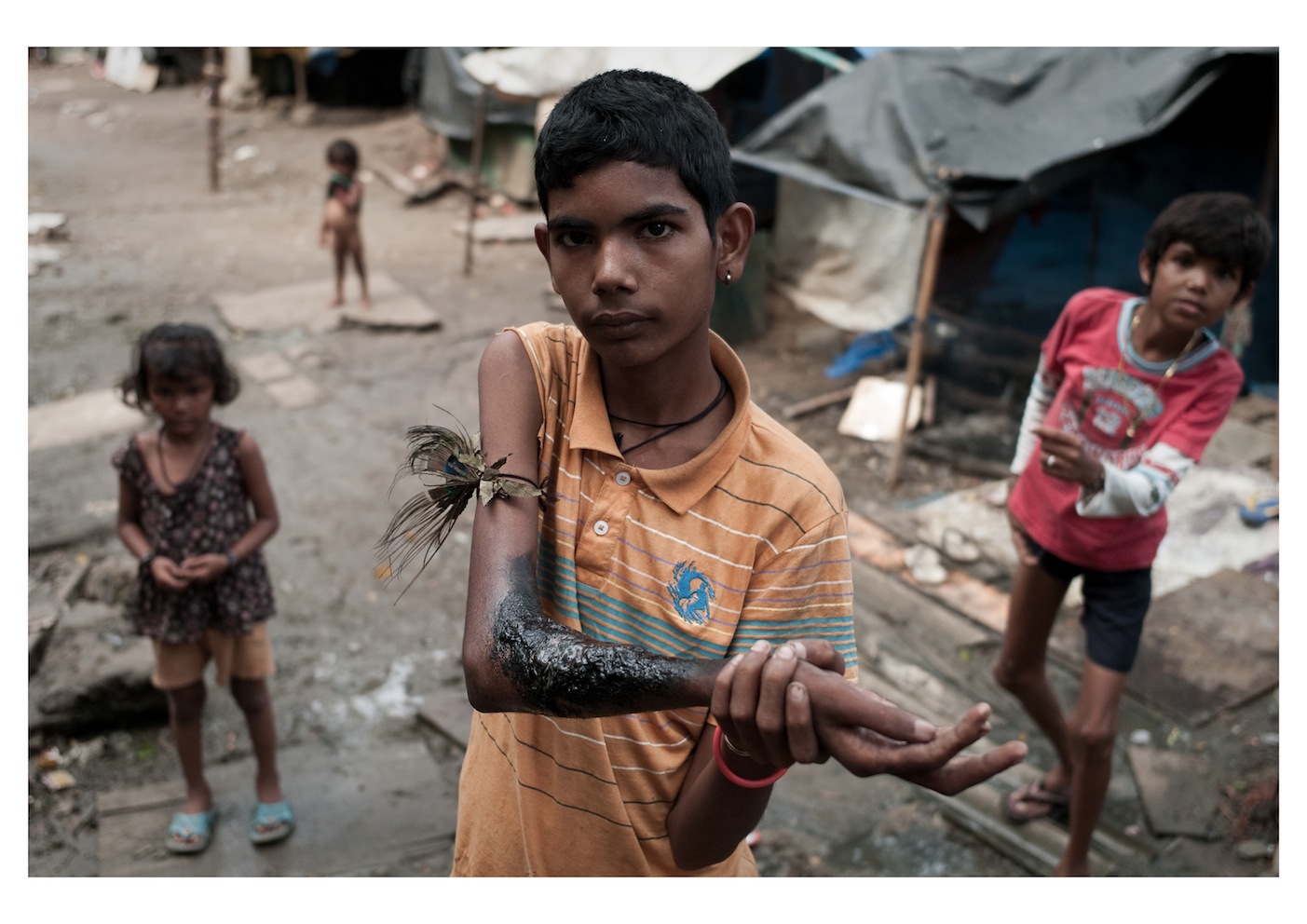 Boy using homemade remedy and peacock feather to heal a terrible wound on his arm, Mumbai