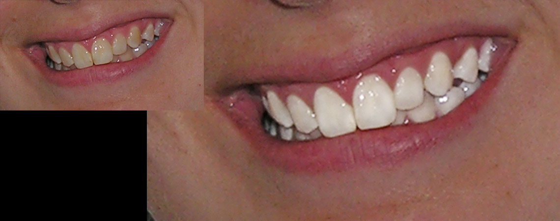 Whiten teeth