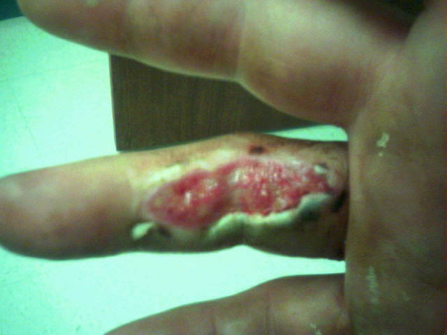 LUKES FINGER SKINNED
