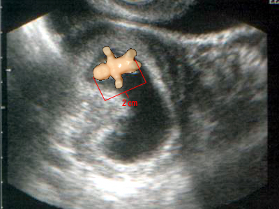 First Ultrasound - 8 weeks