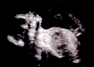 Second Ultrasound - 20 weeks