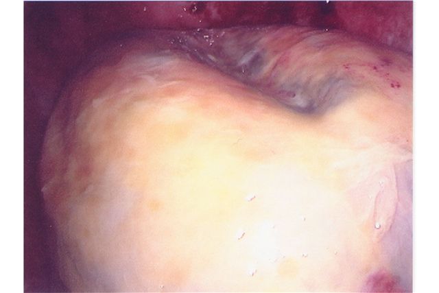 georges tumor 1
