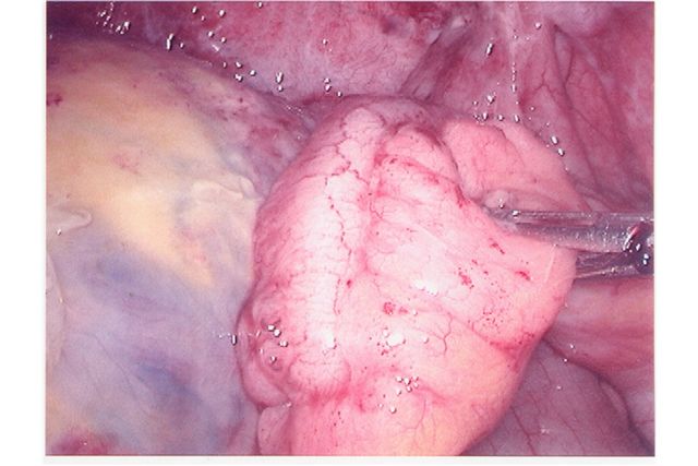 georges tumor 2