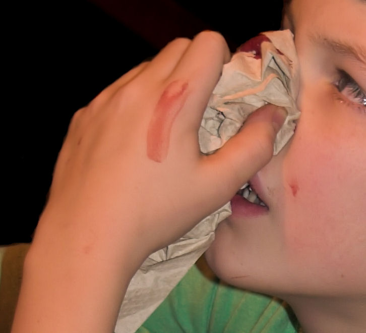 nosebleed