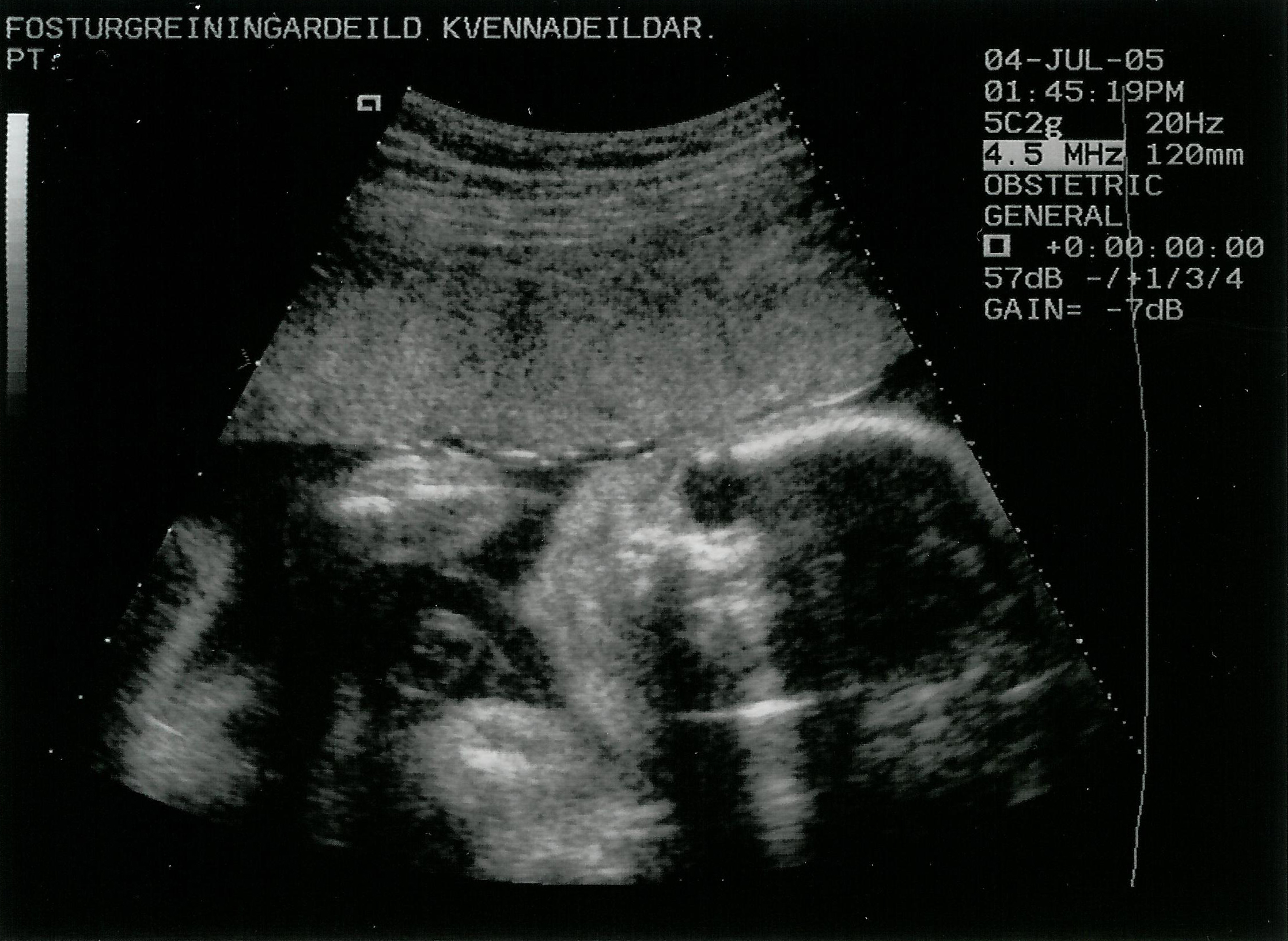 2nd trimester ultrasound