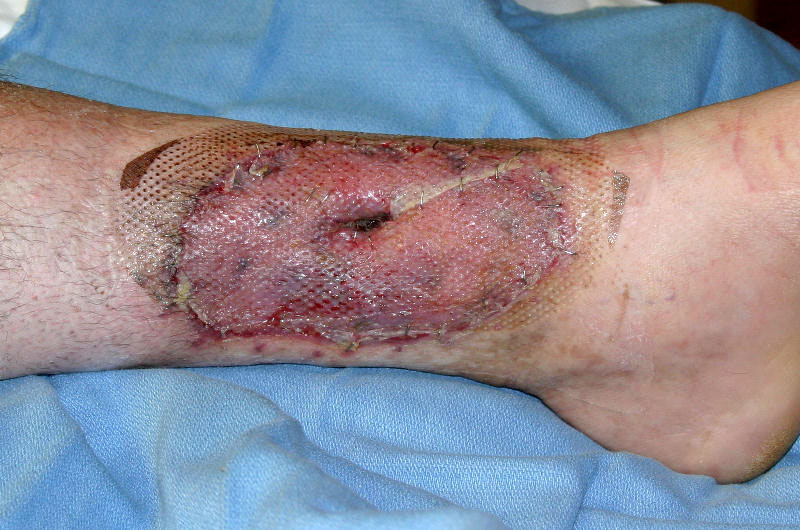 June 26 Photo 1, 7 Days After Skin Graft, 65 Days After Burn