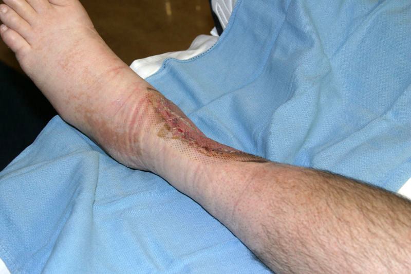 June 26 Photo 2, 7 Days After Skin Graft, 65 Days After Burn