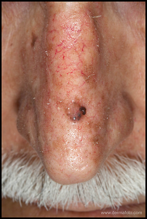 BASAL CELL CARCINOMA.jpg