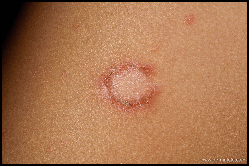 IMPETIGO_05.JPG