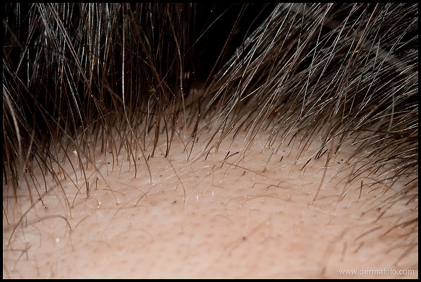 ALOPECIA AREATA_01.JPG