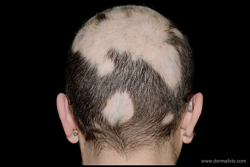 ALOPECIA AREATA_02.JPG