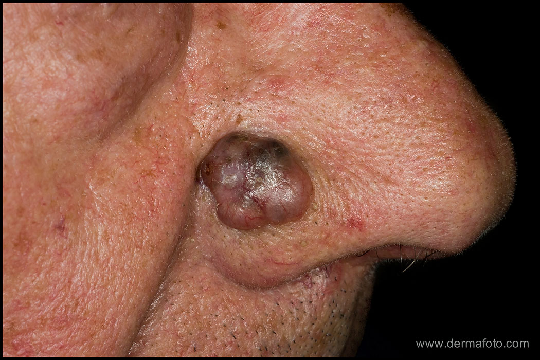NODULAR BASAL CELL CARCINOMA