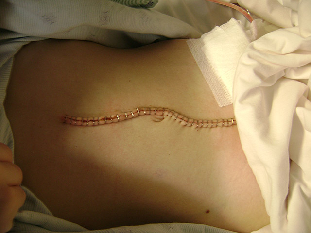 Zachery's Incision  Week 2