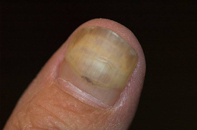 right thumb on doxy from june 2005 in sept 2005.  STOP FISHING.