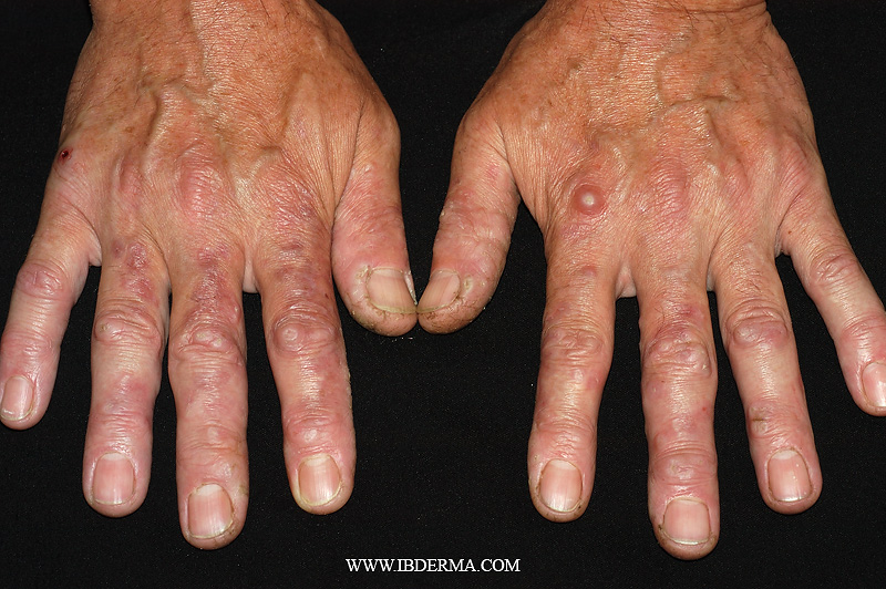 PERFORATING GRANULOMA ANNULARE 1