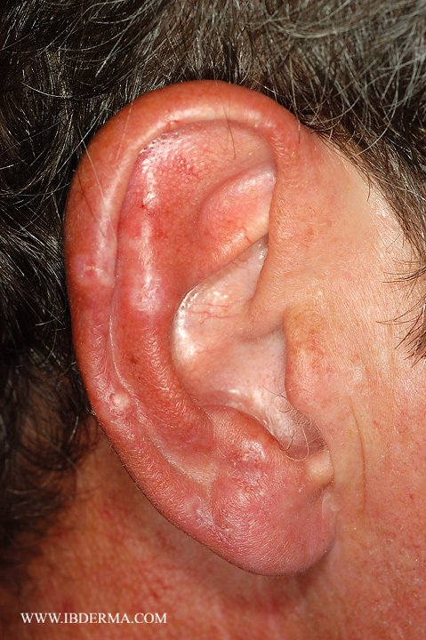 PERFORATING GRANULOMA ANNULARE 4