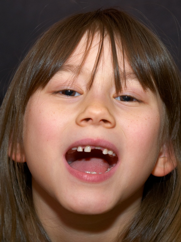 2008-03-28 Nicole missing a tooth