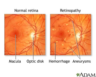 diabetic retinopathy.jpg