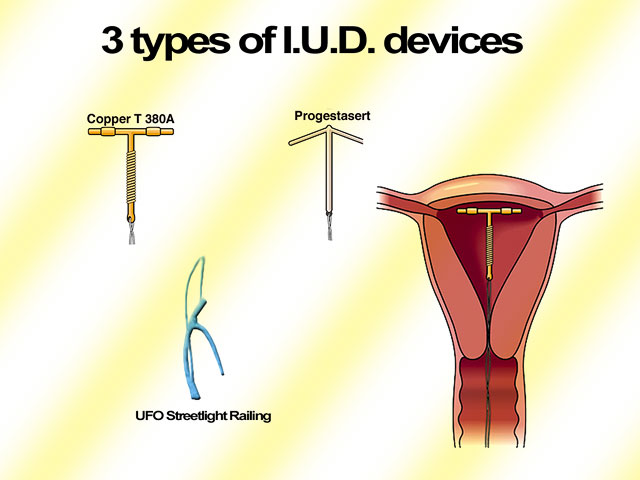 I.U.D.jpg