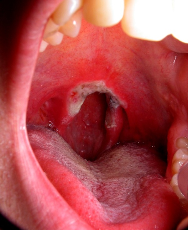 Open Mouth *