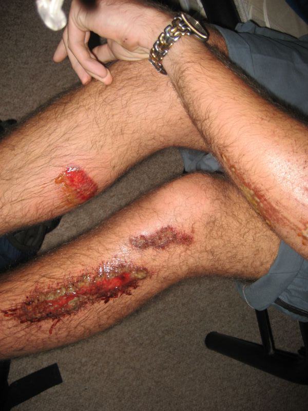 Scabs