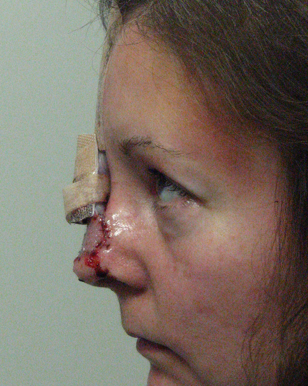 Stage One Surgery Post Op 1 Day Post Op Profile