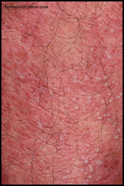 PUSTULAR PSORIASIS_01.JPG