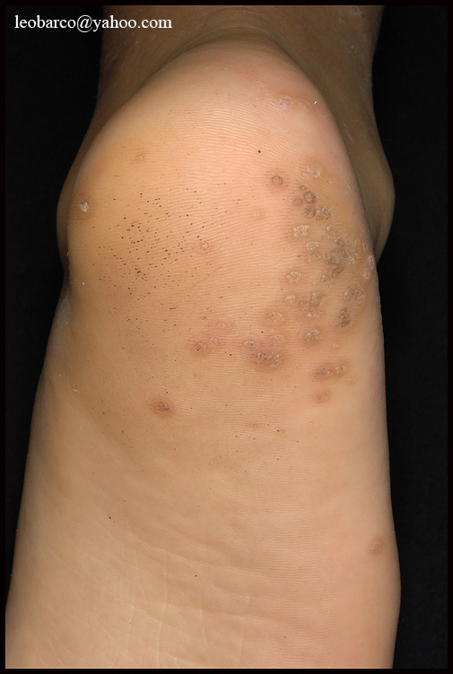 MOSAIC PLANTAR WARTS 01.jpg