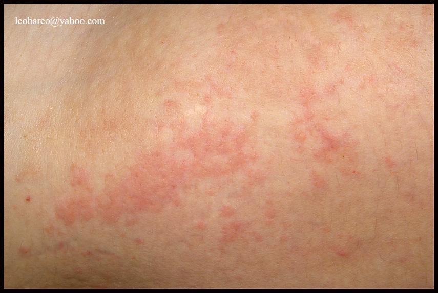 URTICARIA.JPG