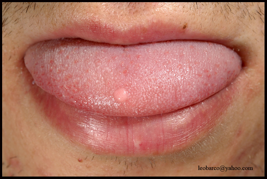 TONGUE FIBROMA/ FIBROMA LINGUAE.jpg