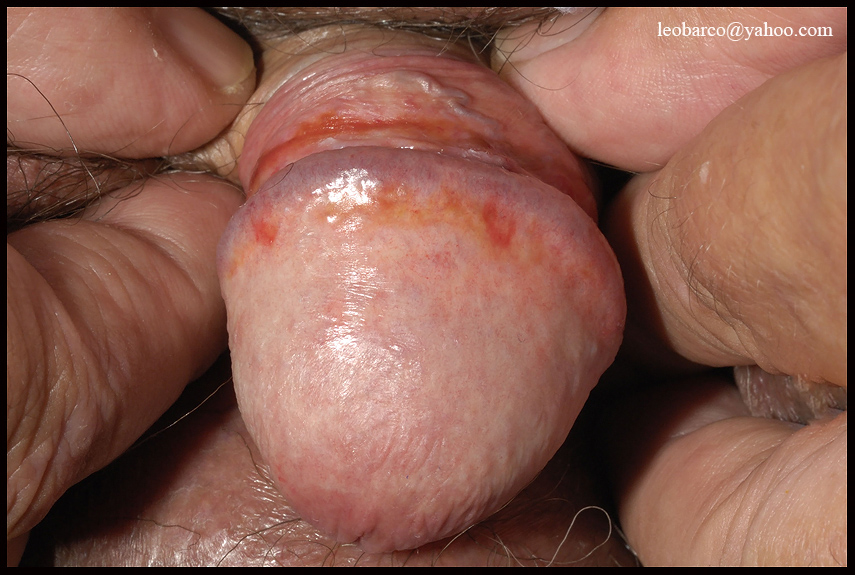ZOONS BALANITIS.jpg