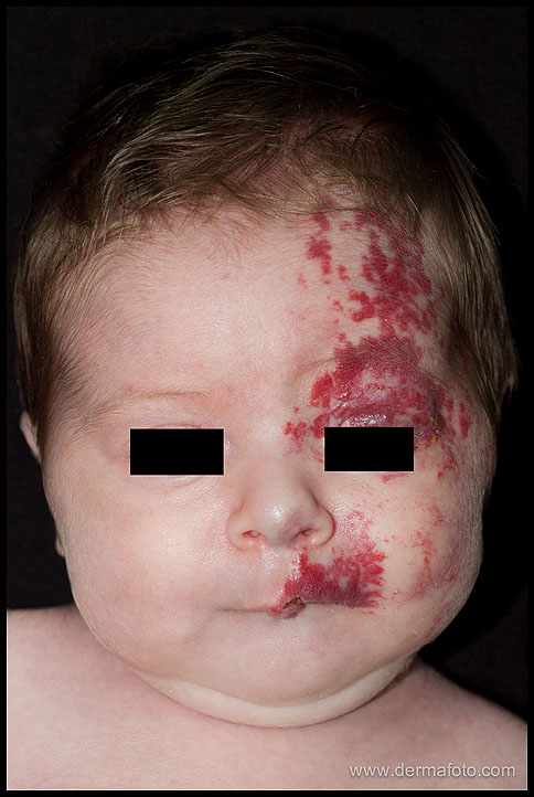 HAEMANGIOMA_HEMANGIOMA_03.JPG