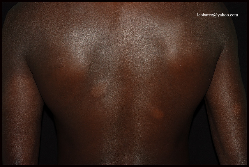 LEPROSY04.jpg