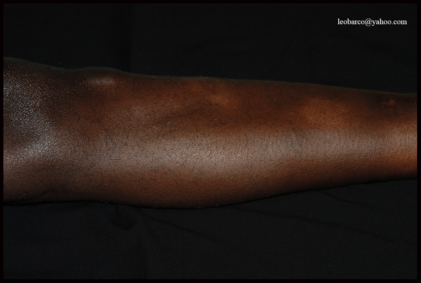 LEPROSY05.jpg