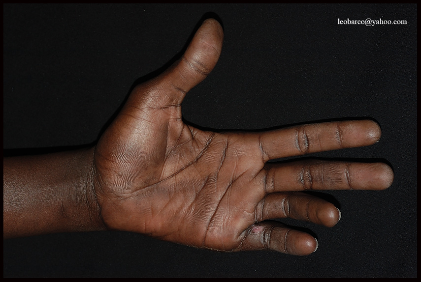 LEPROSY07.jpg