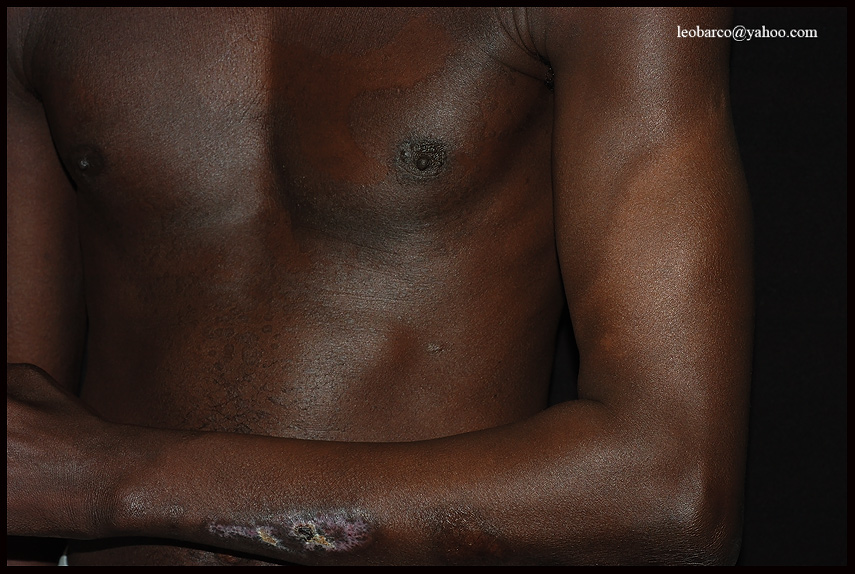 LEPROSY+VERSICOLOR.jpg