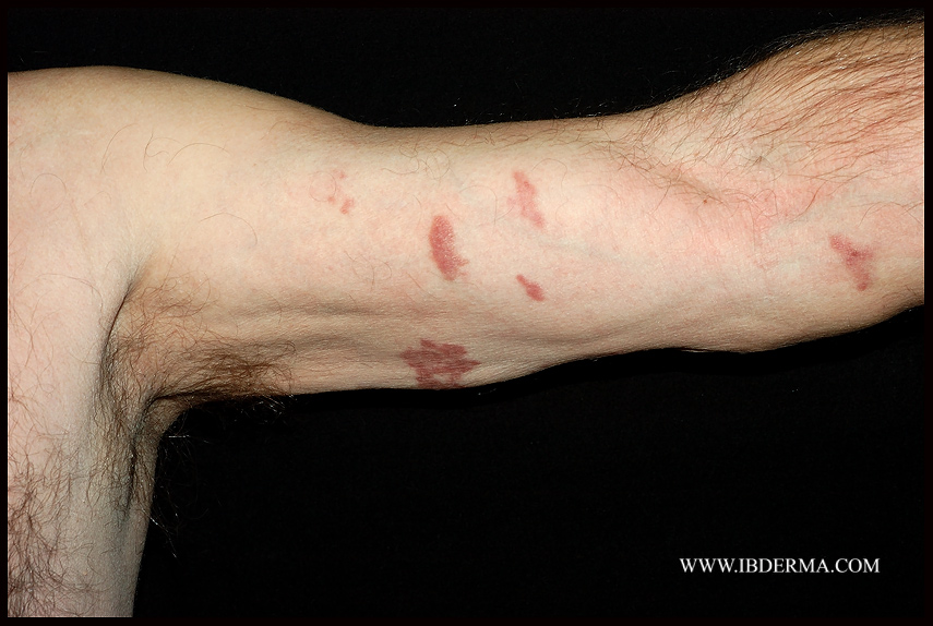 KAPOSIS_SARCOMA01.jpg