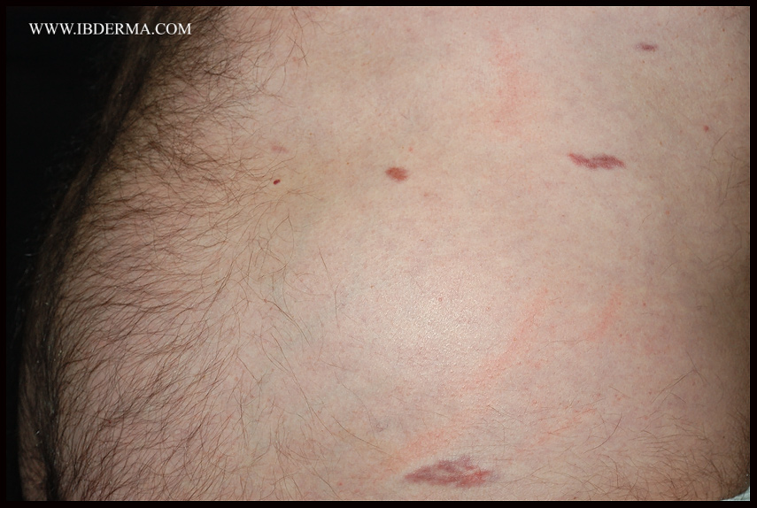 KAPOSIS_SARCOMA02.jpg
