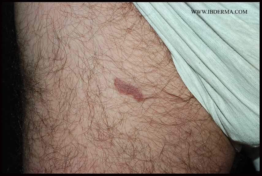 KAPOSIS_SARCOMA03.jpg