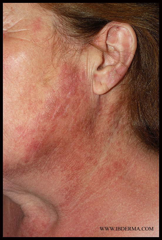 SUBACUTE_LUPUS+POIKILODERMA.jpg