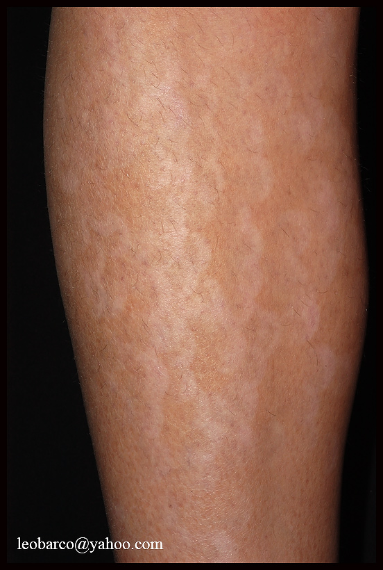 hypomelanosis01.jpg