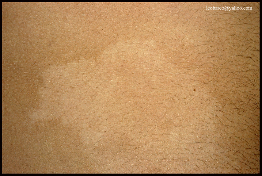 nevus depigmentosus_02.JPG