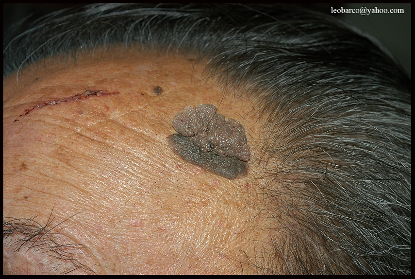 seborrhoeic keratosis_01.JPG