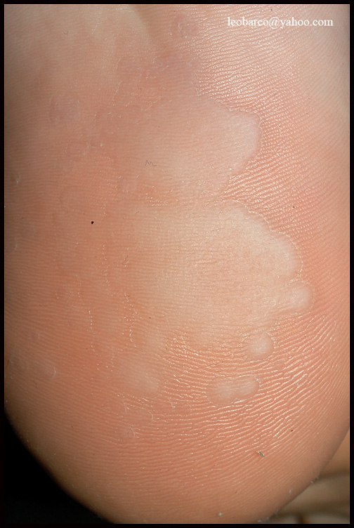 pitted keratolysis_03.JPG