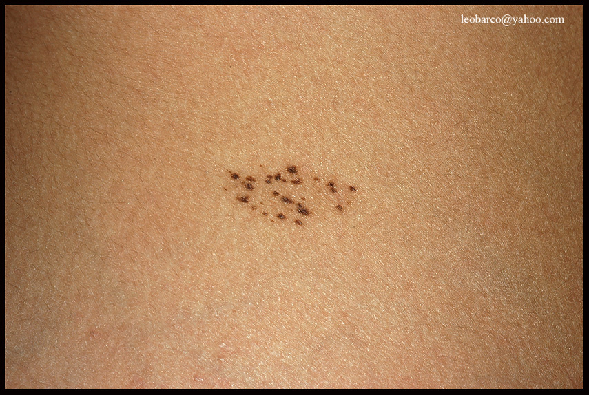 NEVUS SPILUS_01.JPG