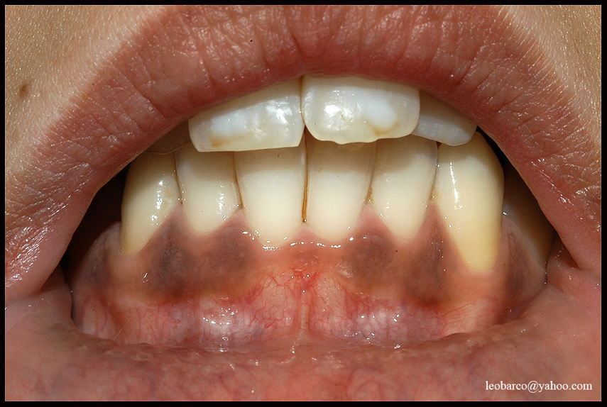 PIGMENTED TEETH+GUM.jpg