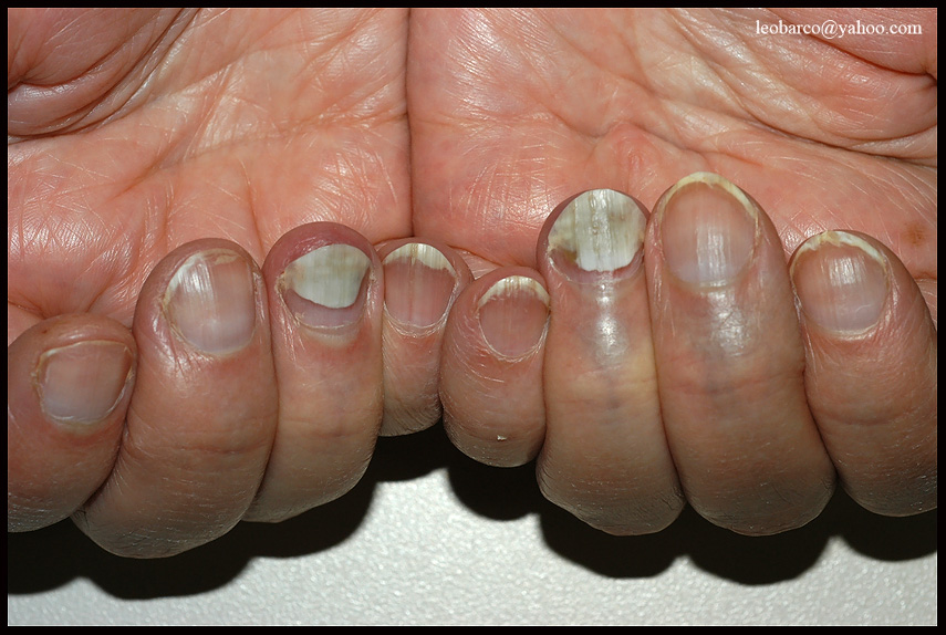 TINEA UNGUIUM.jpg