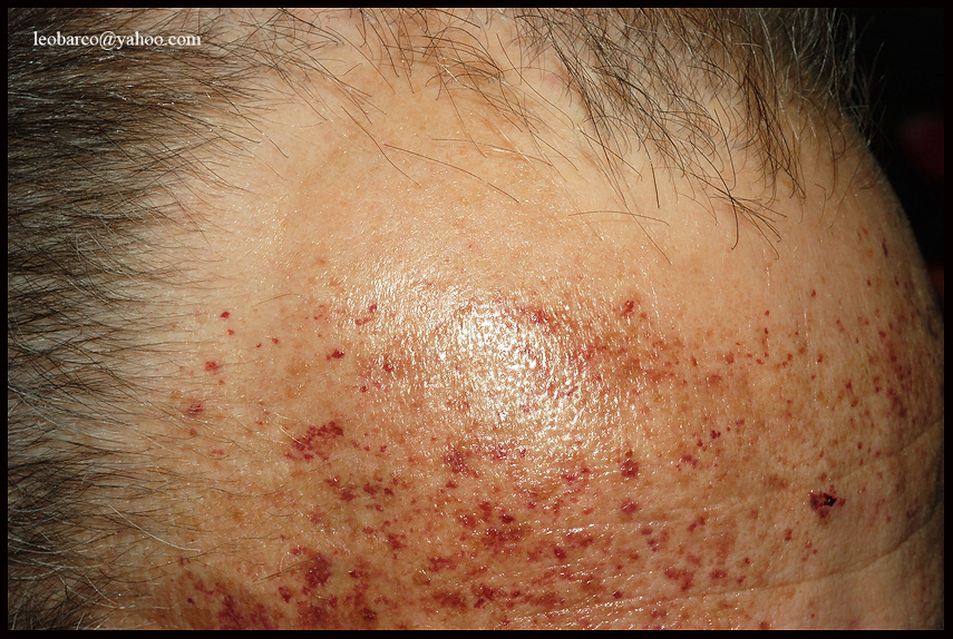 amyloidosis_02.jpg